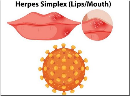 at home herpes treatment