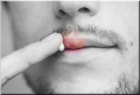 natural herpes treatment