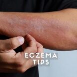 how to cure eczema fast at home