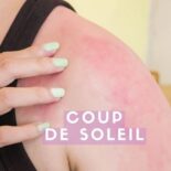 comment faire dérougir un coup de soleil