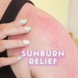 best sunburn relief