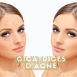 traitement naturel cicatrices d'acné