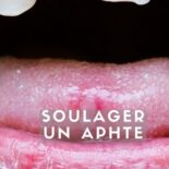 soigner un aphte