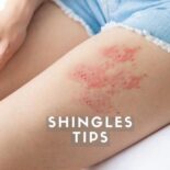 how to recover from shingles quickly