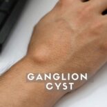 holistic treatment for ganglion cyst