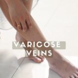 varicose veins in legs