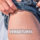 comment faire disparaitre les vergetures