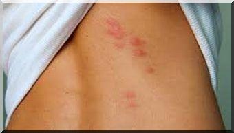  bed bug bite photo