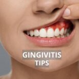 gingivitis vs periodontitis
