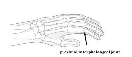 ra nodules fingers