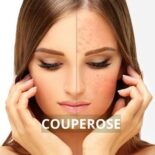 couperose visage