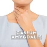 caseum comment l enlever