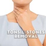 tonsil stones smell