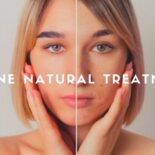 home remedies for acne