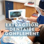 comment faire dégonfler une joue rapidement après extraction ?