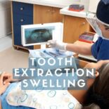 tips to reduce facial swelling after tooth
