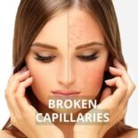 couperose skin natural treatment