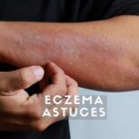 comment soigner eczema