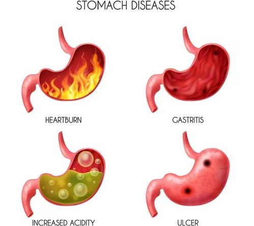 common stomach problems