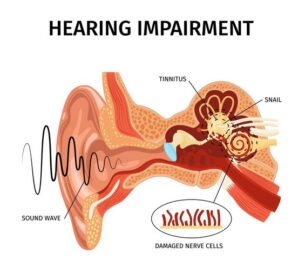 tinnitus dizziness menieres disease
